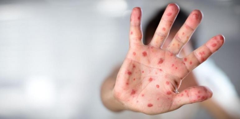 Потвърден е трети случай в България на мъж заразен с